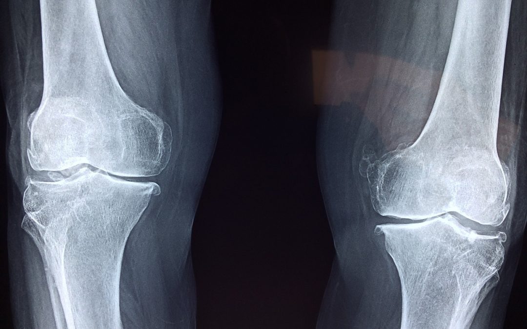 Usura della cartilagine del ginocchio